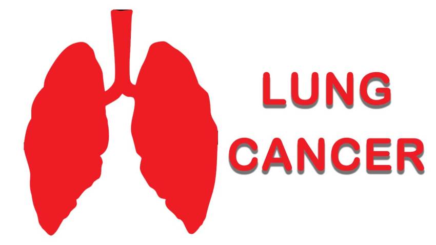 Lung Cancer Treatment Cost in India (Image: Pixabay)